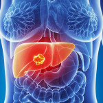 Karaciğer kanseri dünyada sıklık olarak tüm kanserler içinde 5. sırada ve kanserden kaynaklanan ölümler arasında 3. sırada yer alıyor.