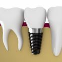 implant diş